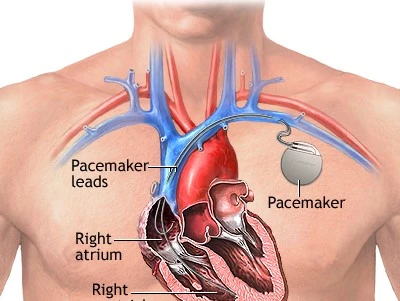 Pacemaker Blog