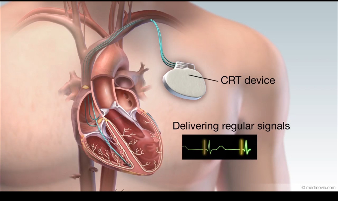 Heart Failure Diagram