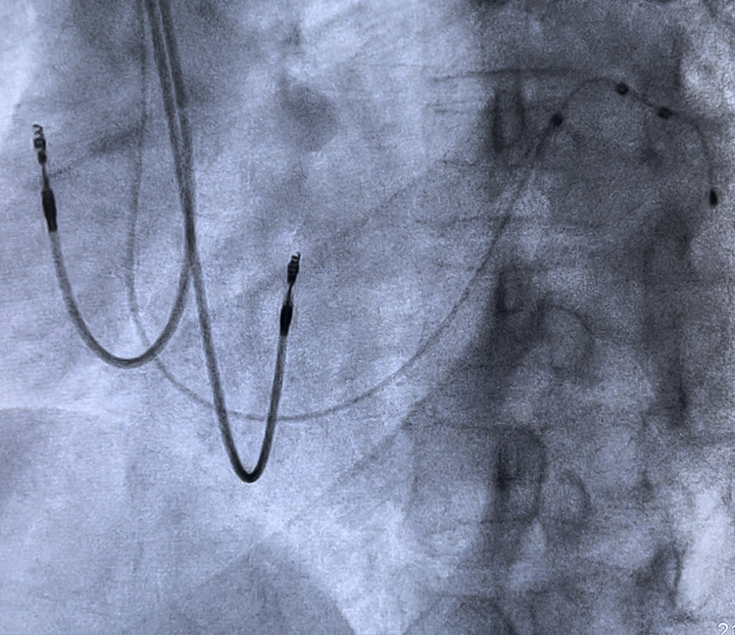 Normal Heart vs Heart Failure